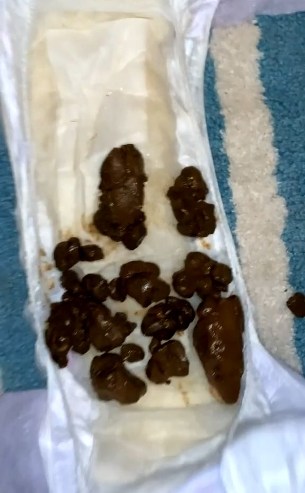 Poop balls in a diaper close-up.